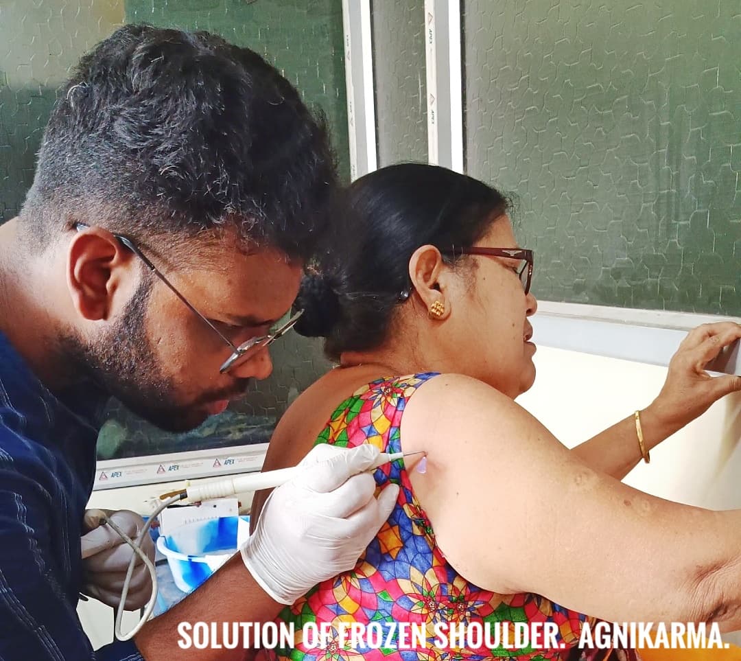 Agni Karma Treatment